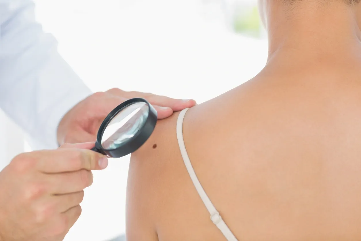 The Importance of Regular Skin Cancer Screenings