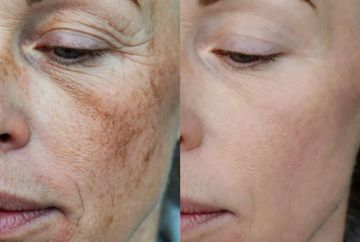 Before and after ablative co2 laser and neurotoxins
