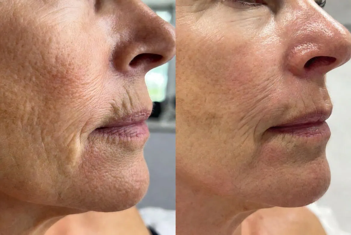 Before and after neurotoxin filler and 3 IPL sessions